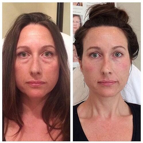 Girl after and after laser rejuvenation