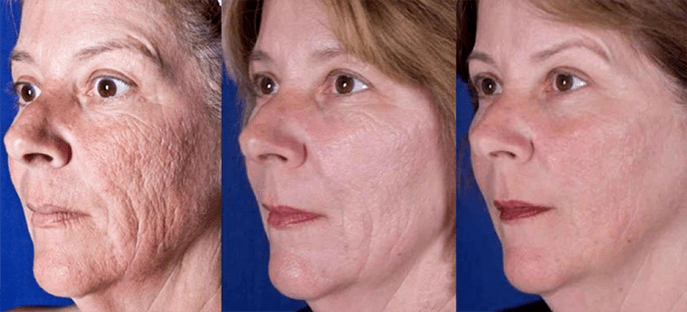 Result after laser skin rejuvenation procedure
