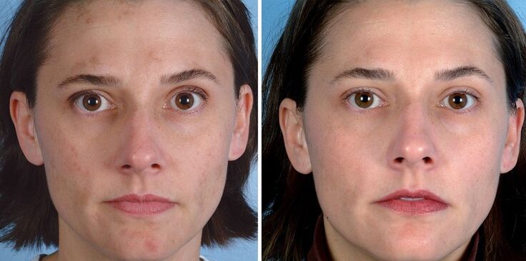 Apparatus before and after skin rejuvenation