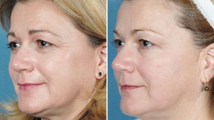 Photos of techniques before and after skin rejuvenation