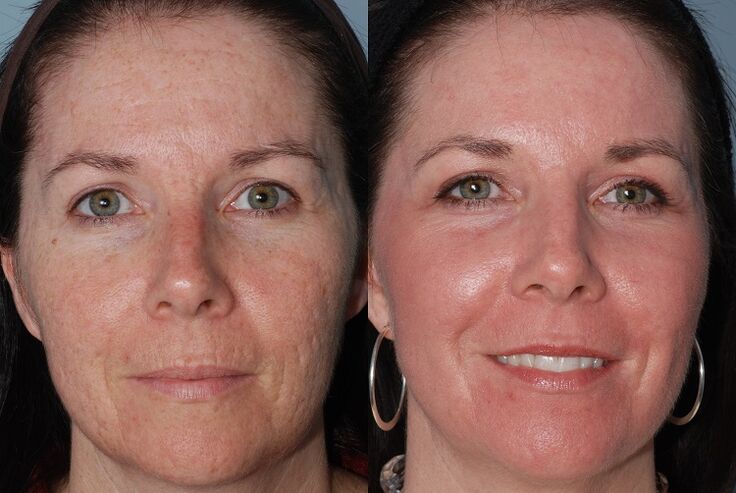 Techniques before and after skin rejuvenation