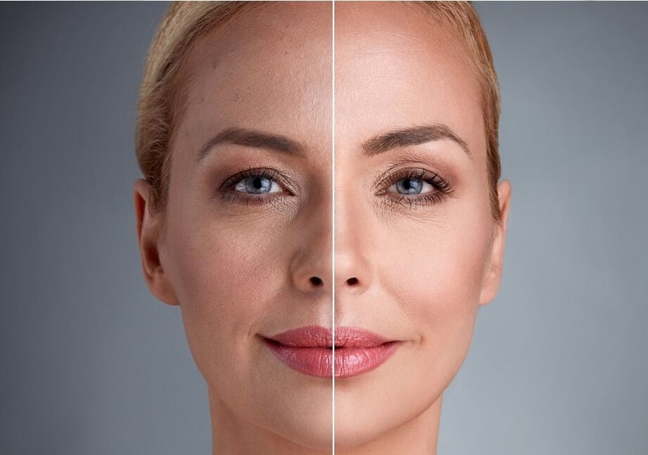 Facial laser before and after rejuvenation