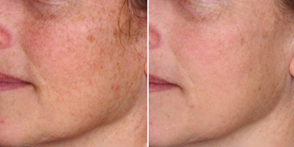 Facial skin before and after rejuvenation