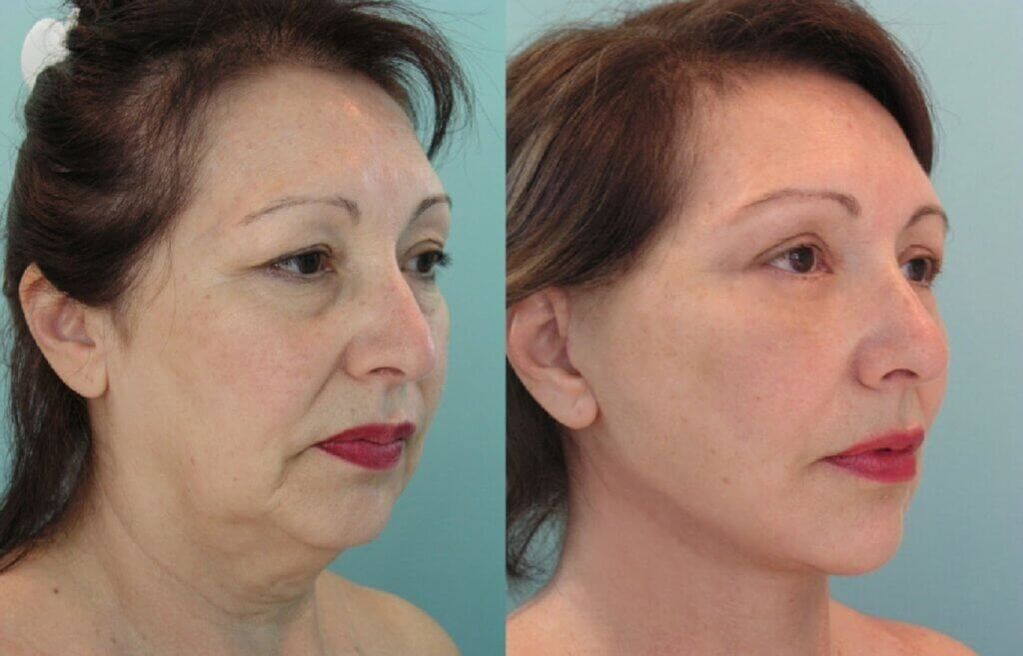 Photo before and after skin rejuvenation